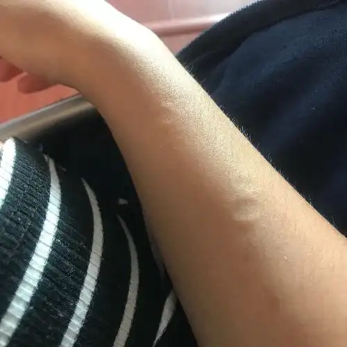 胳膊上突然出现小坑