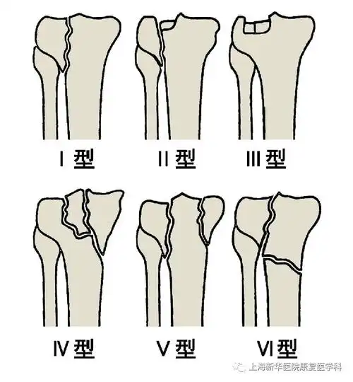 胫骨平台骨折术后的康复治疗