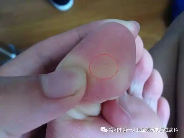 别再傻傻的鸡眼,跖疣分不清啦!