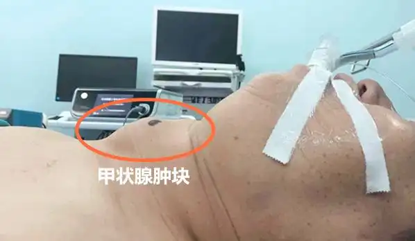 西安大兴医院为患者摘除长了29年的甲状腺肿瘤西部网 2020-04-24 14