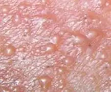 有学者认为本病症属于一种生理发育的异常.