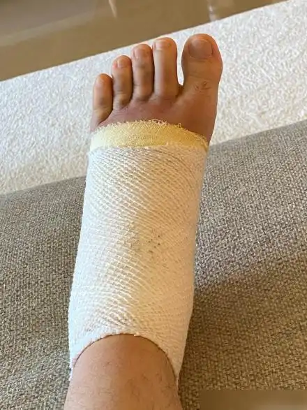 淤青,整个脚肿到不止像个肉包,还像个萝卜,隔着绷带都能感受到疼痛