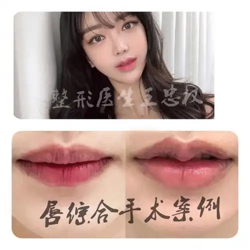 m唇案例分享一例_美度医疗美容医院攻略_微笑唇_医疗美容_红薯_m唇_美