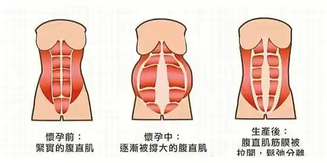 产后修复腹直肌分离