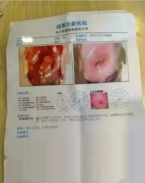 宁密康宫颈纳氏囊肿案例