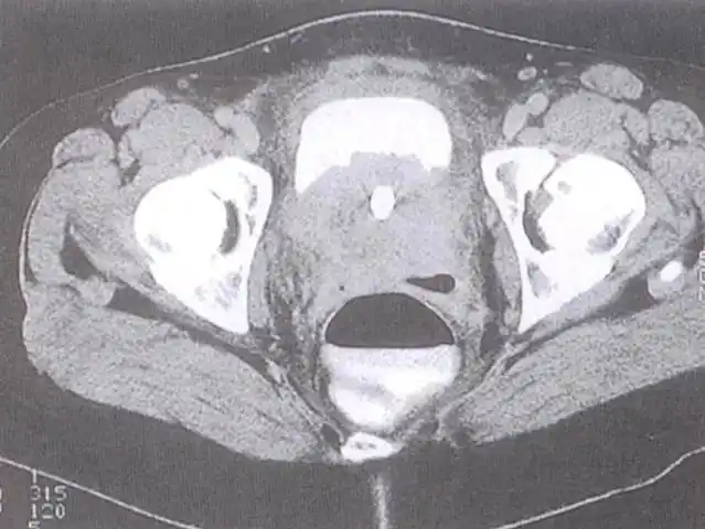 有时还会有血尿,到医院一检查,得了尿道癌,而且都已经沿着尿道口长出