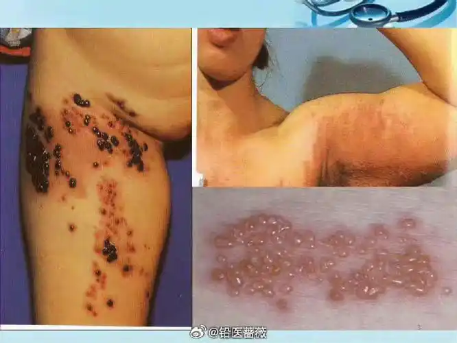 很多网友说带状疱疹反正也治不好,用药都是骗人的,让他自己自愈就行了