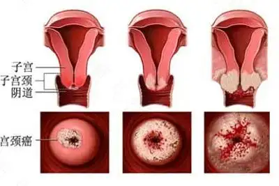 宫颈口组织增生需要治疗么