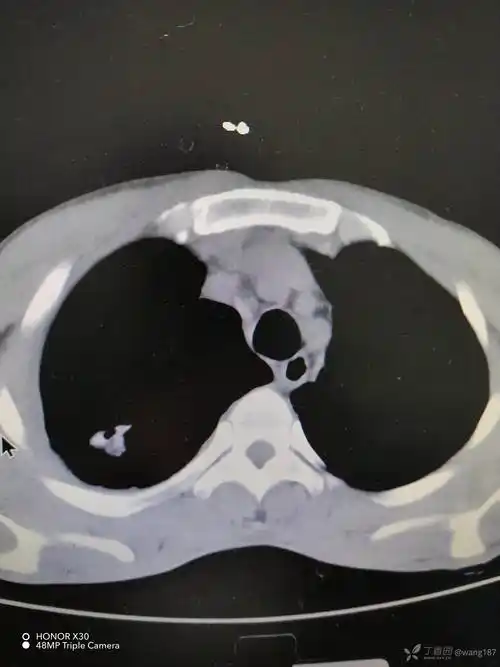 青年男性的胸腔积液