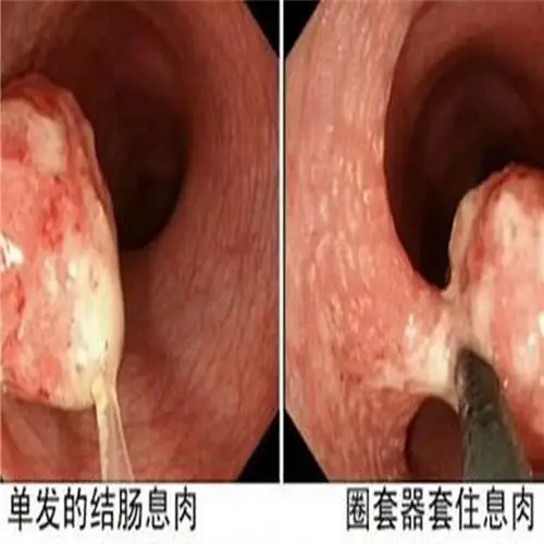 直肠息肉