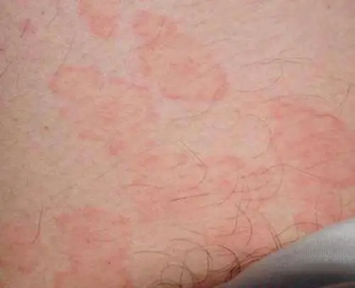 女性梅毒症状图片大全_有来医生