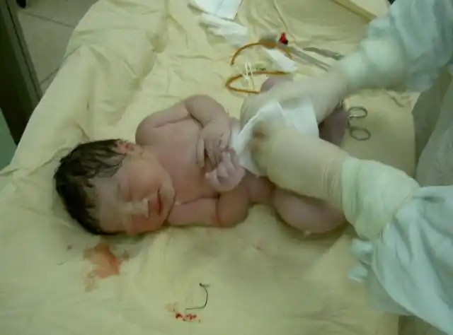我详细的剖腹产生女全过程实拍产房内生产的真实图片