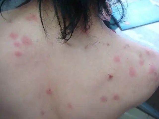 蜱虫叮咬后瘙痒持续了一周,怎么办?