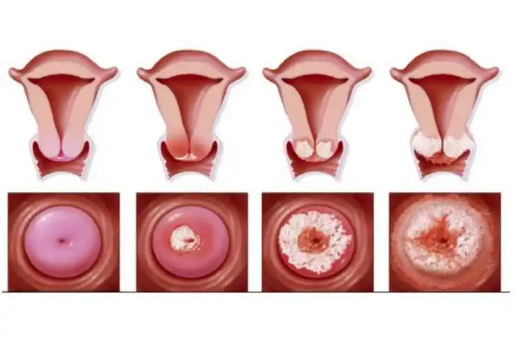 hpv病毒女性症状图片