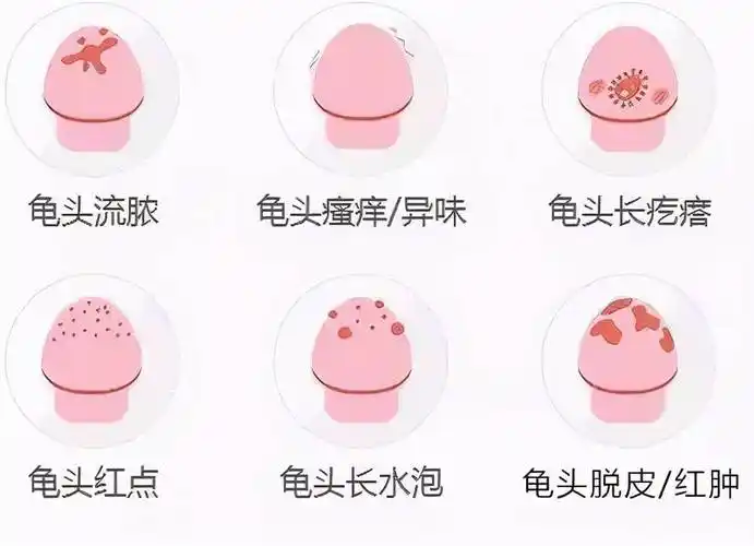 包皮龟头炎怎么治疗龟头炎怎么治疗男性