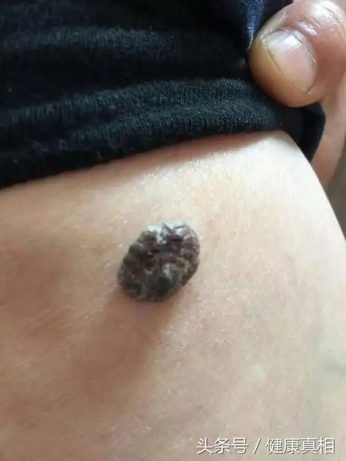 身上有个黑痣要小心很可能是癌症在作怪
