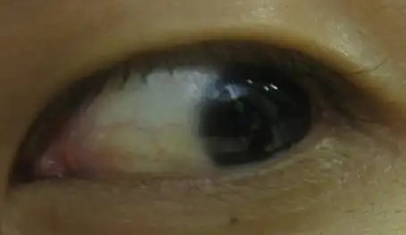 肝脏被损害的症状:眼睛发黄,疲劳乏力,肝掌—【nmn观察】