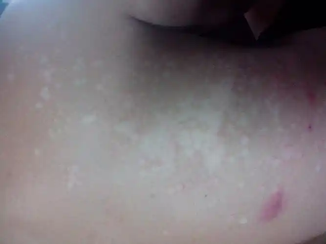 我背上长了些白色的斑点,开始只有一小点过了几个月就变成了现在这样