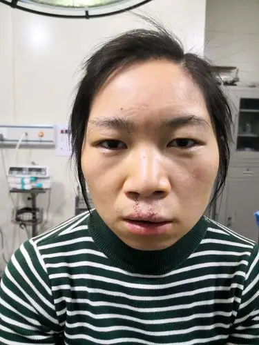 唇裂二期修复