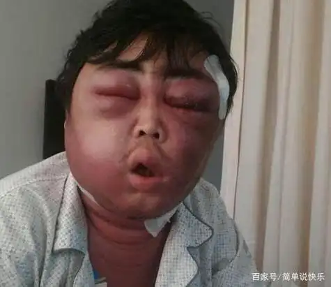 每日一笑,愚人节我被揍的鼻肿脸青