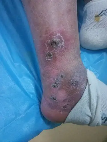 变应性皮肤血管炎一例