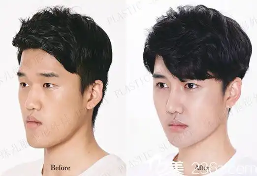 隆鼻手术前后效果对比照片