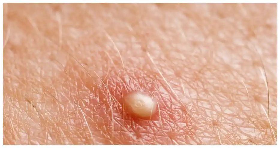 女性注意如果下面长疙瘩别随便抠去查查hpv