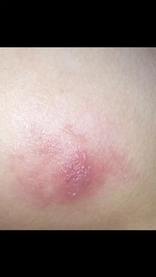 屁股上这块皮肤,一到夏天就开始又红又肿又发痒,而且是很痒,还会长小