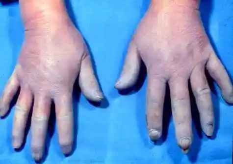 p> a target="_blank" href="/item/雷诺现象/3526967" data-lemmaid