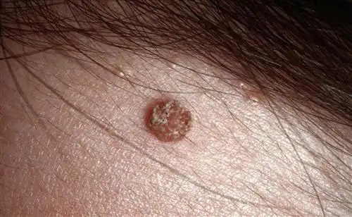 手心寻常疣怎么治疗