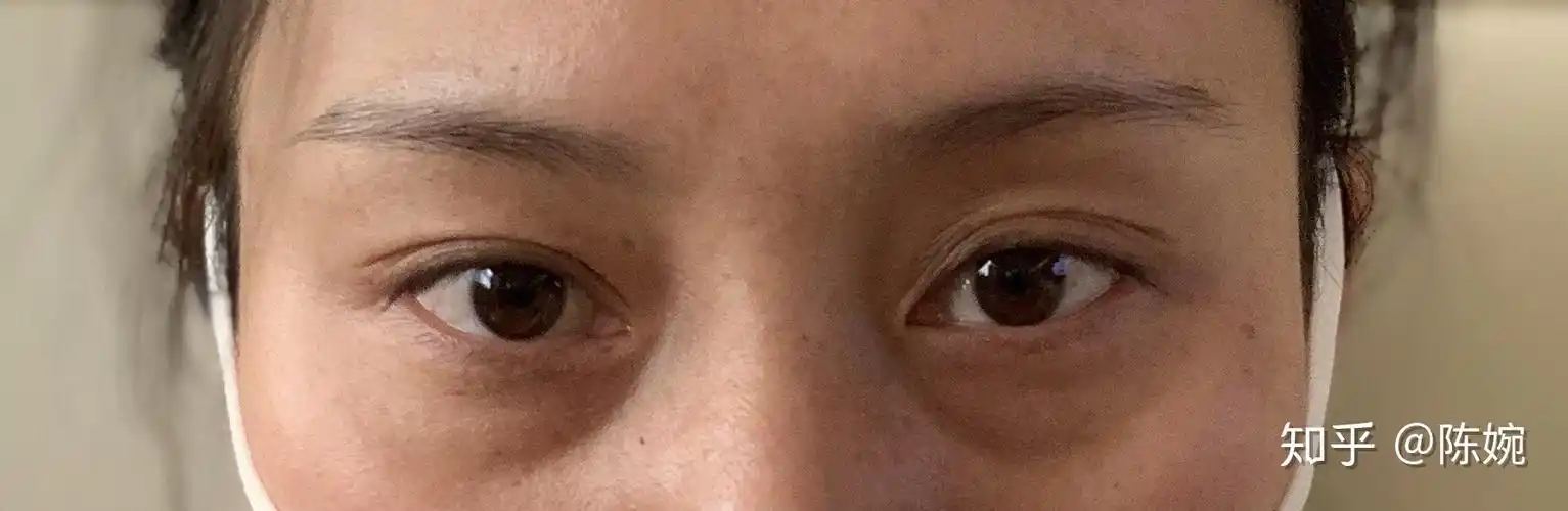 外切眼袋泪沟填充实录 - 知乎