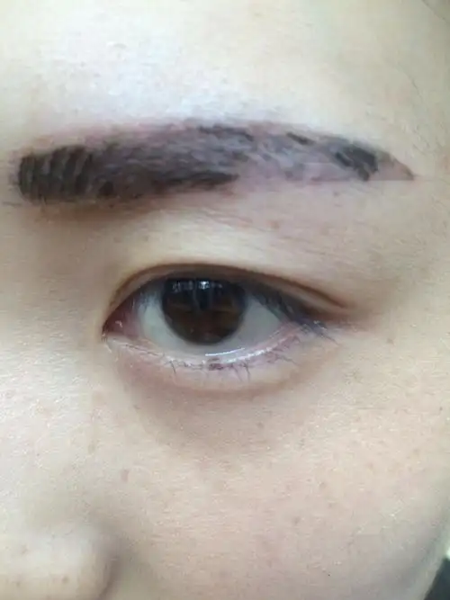 纹眉结痂,掉了一部分,皮肤发红,是不是留疤了,求大神解答!