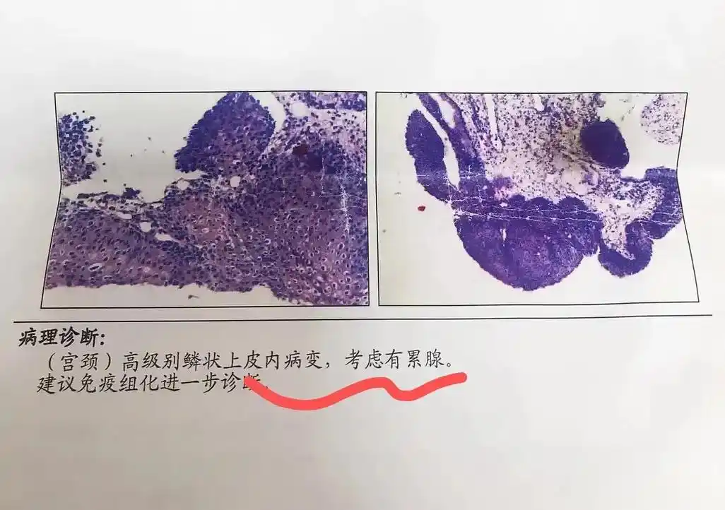 母亲操碎的心,女儿悔恨的泪.这位患者32,感染了hpv16, - 抖音
