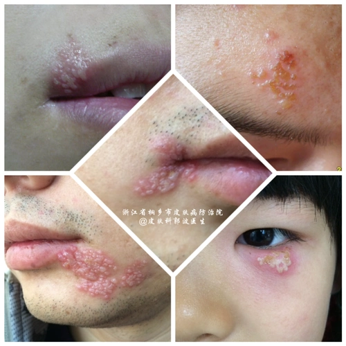 单纯疱疹_疾病介绍_症状_预防 - 好大夫在线