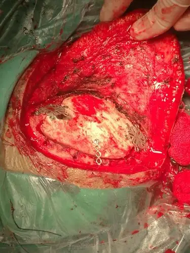 左侧小脑脑膜瘤 68岁女性,头痛伴行走不稳一月余入院