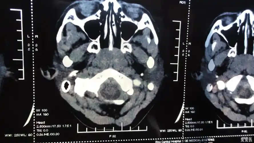 内科大夫求助增殖体肥大