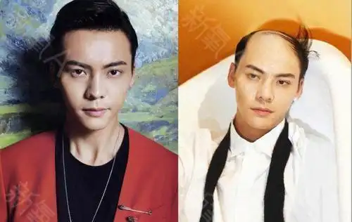 植发#植发是中年男星颜值的保鲜剂,要想40不演爹_圈子-新氧美容整形