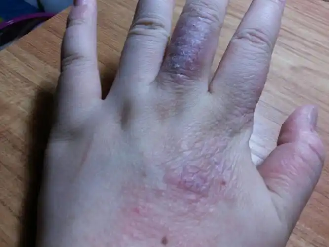 18岁高三学生,今年高考,去年手上有一粒一粒红的然后有点痒手上开始褪