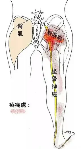 久坐屁股痛,小心梨状肌综合征!
