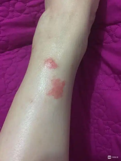 家里的蚊子是成精了么?被咬了之后腿竟然变成了这样