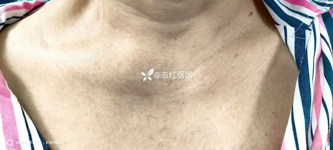 被漏诊10年的胸锁关节紊乱