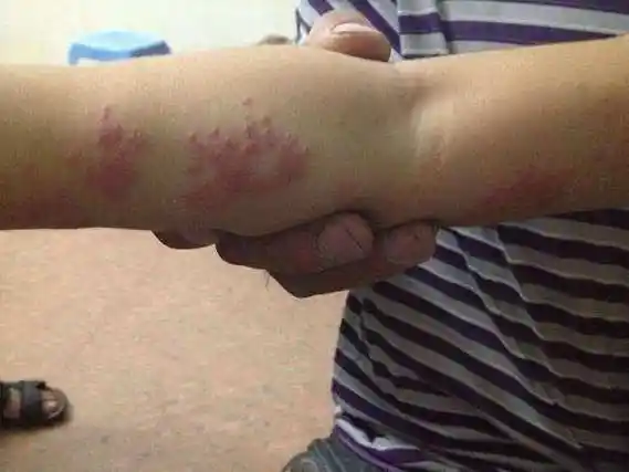 带状疱疹能自愈吗?得了带状疱疹要注意哪些事项?