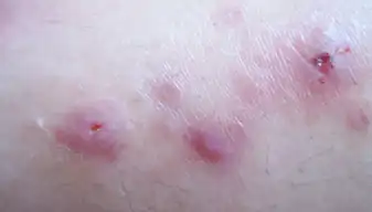 男性梅毒一期症状图_医学知识全接触_按疾病找科普知识_挂号通