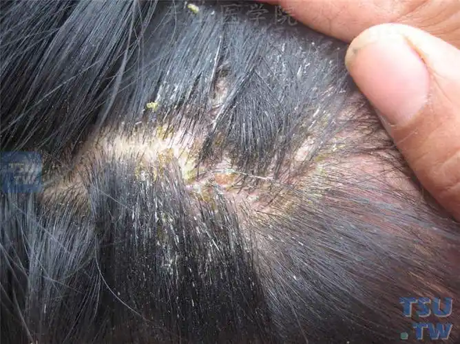脂溢性皮炎(seborrheic dermatitis)症状表现