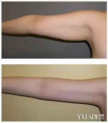 【图】快速瘦手臂一周见效的方法 快速告别蝴蝶袖的方法大全