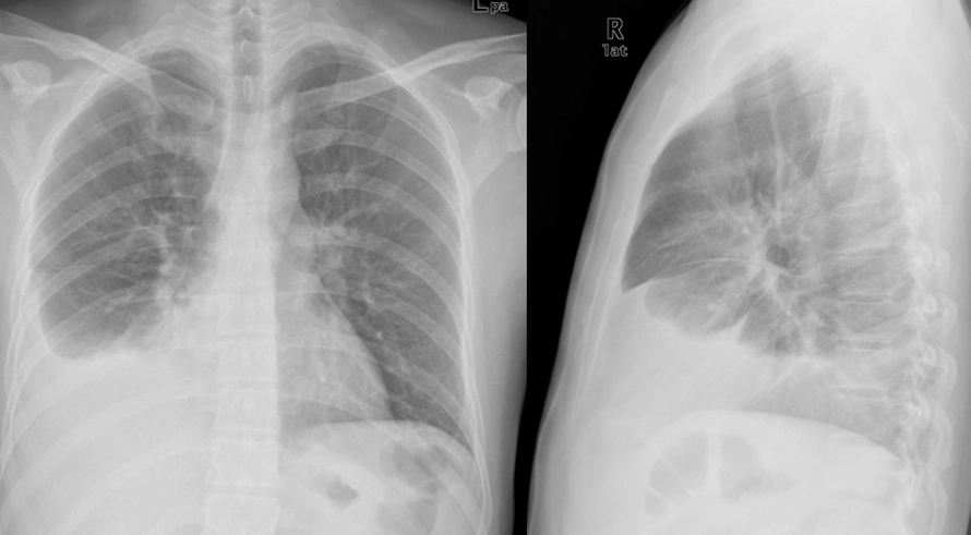 如果提示有右侧胸腔积液为推测病原进行的特异性最高的诊断方法应是