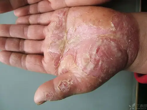 【共享】掌跖脓疱病