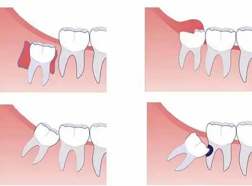 在医学上,智齿被称为第三磨牙,是从两个门牙的牙缝开始向内数的第八颗