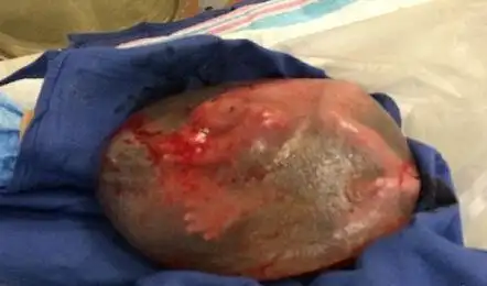 羊水未破宝宝裹水球出生图