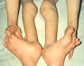 肌肉萎缩 疾病介绍